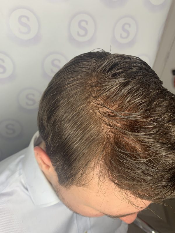 Hair Replacement Manchester