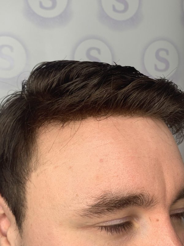 Hair Replacement Manchester After